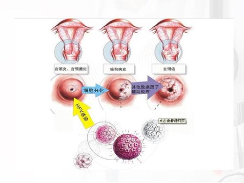 出现宫颈癌的五个征兆（这六个明显信号提示你可能是宫颈癌）