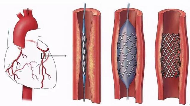 心脏支架从1.3万降至700元的原因（心脏支架从1.3万降至700元）(4)