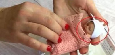 ​世界上最小的婴儿美国的阿米利娅·泰勒 只有一个巴掌那么大