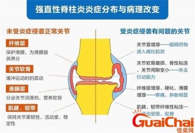 ​强直性脊柱炎6个地方疼用什么药？强直性脊柱炎6个地方疼图