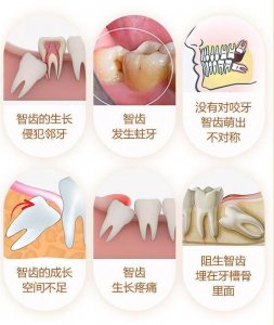 ​我花了2375元拔了四颗智齿要多少钱 拔4颗智齿花了4000