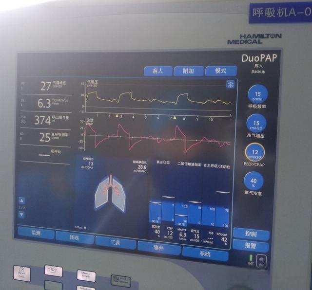 ICU中的呼吸机到底多贵，真是每天费用过万吗？重症医生说实话了-